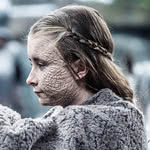 Escamagris: a doença de Game of Thrones